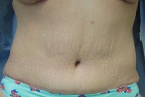 Abdominoplasty