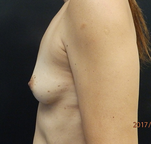 Breast Augmentation