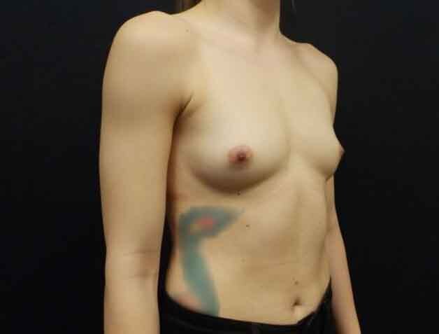 Breast Augmentation