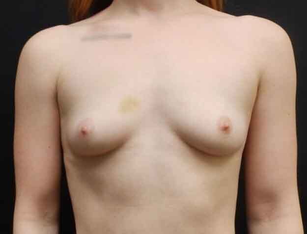 Breast Augmentation