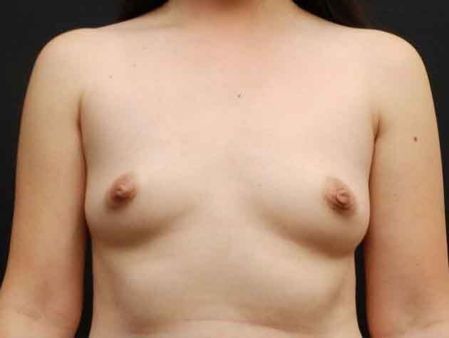 Breast Augmentation
