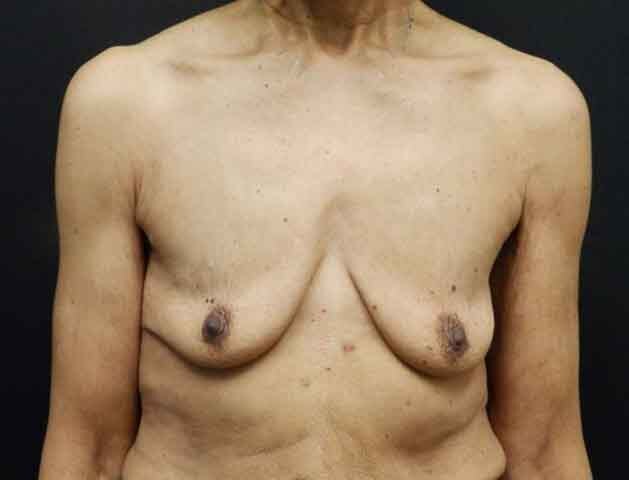 Breast Augmentation