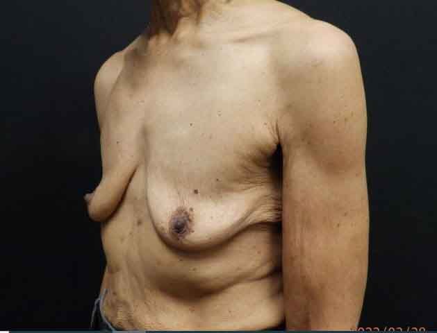 Breast Augmentation