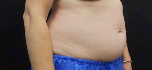 Liposuction