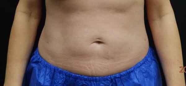 Liposuction