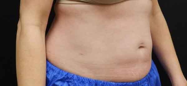 Liposuction