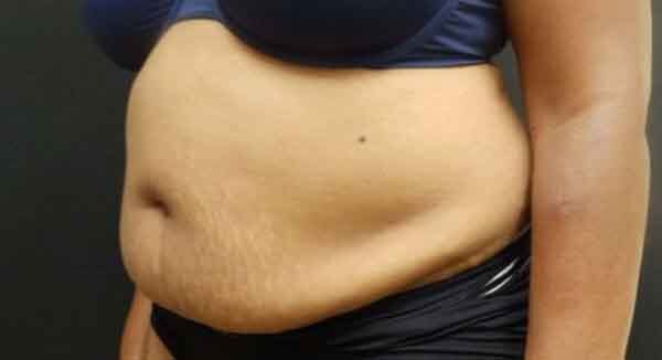 Liposuction