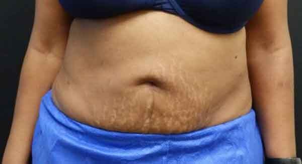 Liposuction