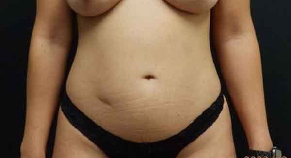 Liposuction