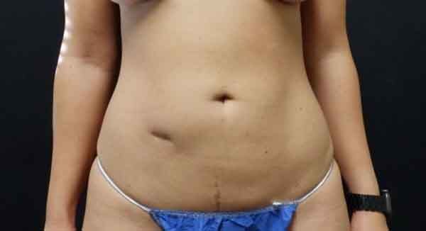 Liposuction