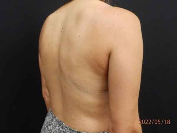 Liposuction