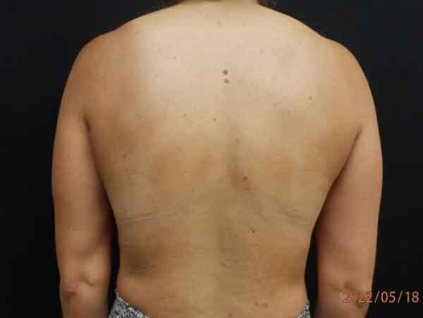 Liposuction