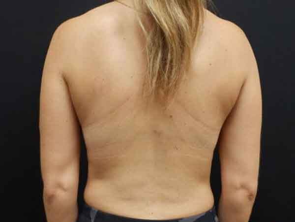Liposuction