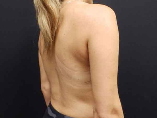 Liposuction
