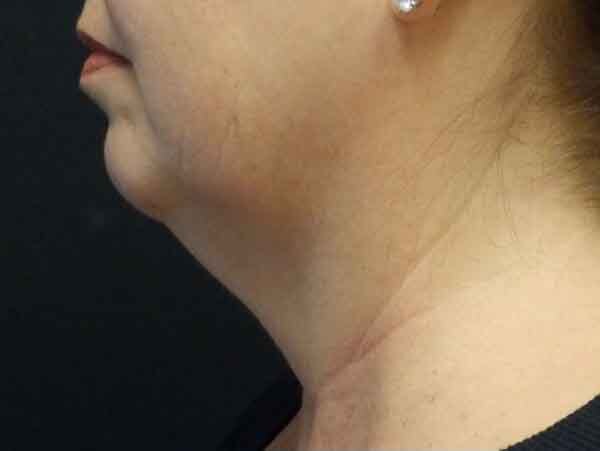 Chin Liposuction