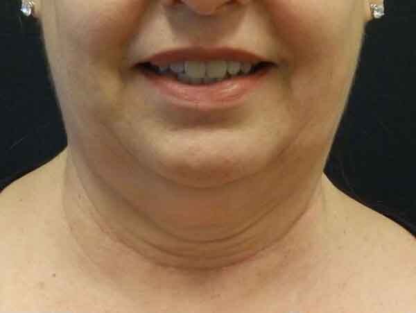 Chin Liposuction