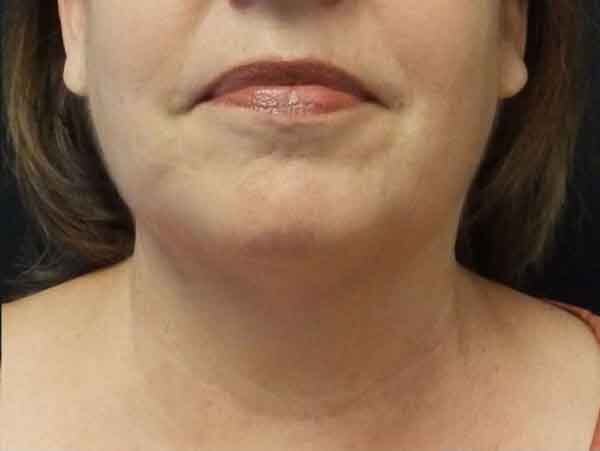 Chin Liposuction