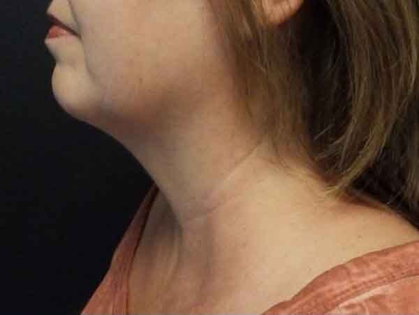 Chin Liposuction