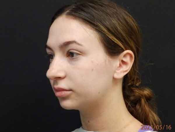 Chin Liposuction