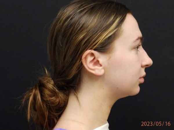 Chin Liposuction
