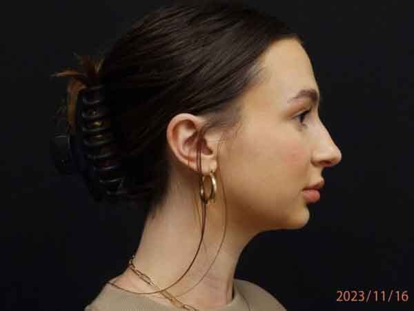 Chin Liposuction