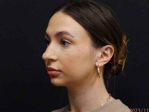 Chin Liposuction
