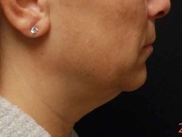 Chin Liposuction