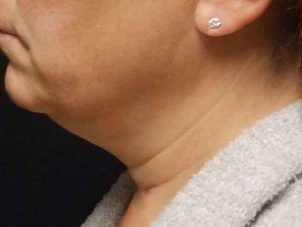 Chin Liposuction