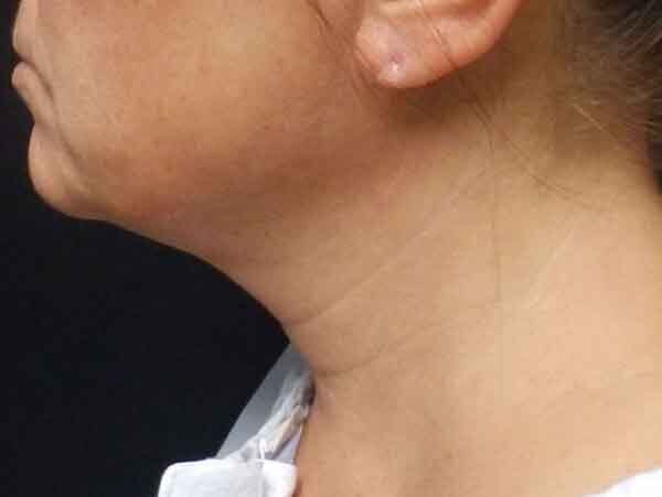 Chin Liposuction