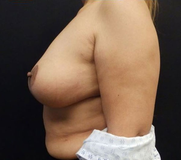 Breast Lift (Mastopexy)
