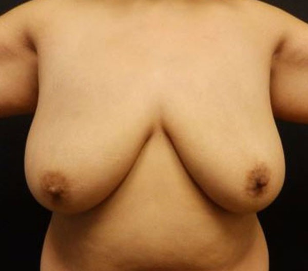 Breast Lift (Mastopexy)