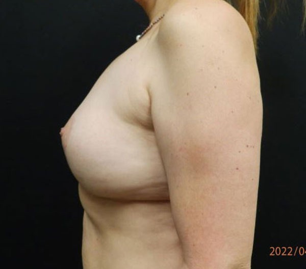 Breast Lift (Mastopexy)