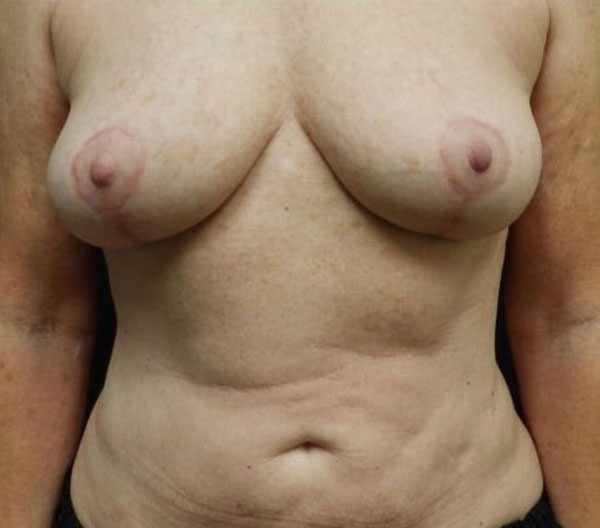 Breast Lift (Mastopexy)
