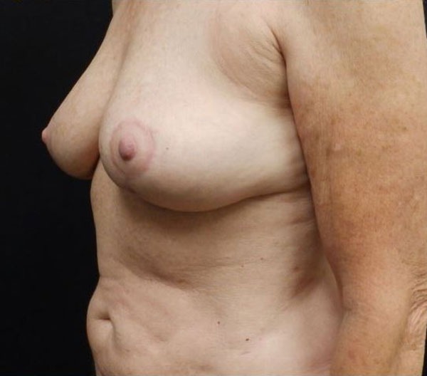 Breast Lift (Mastopexy)