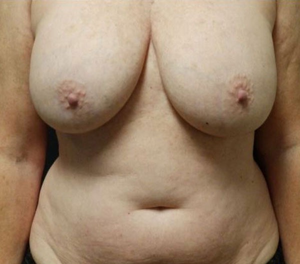Breast Lift (Mastopexy)