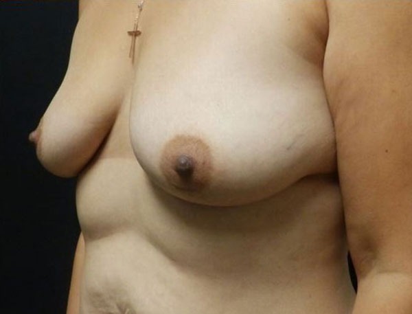 Breast Lift (Mastopexy)