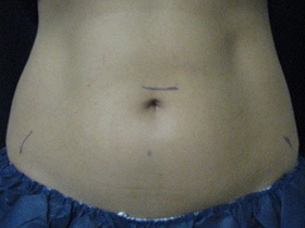 CoolSculpting