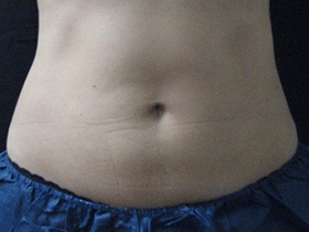 CoolSculpting