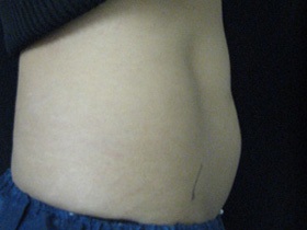 CoolSculpting