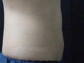CoolSculpting