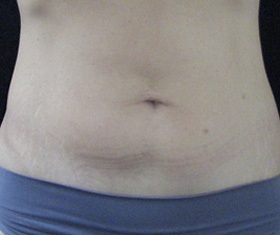 CoolSculpting