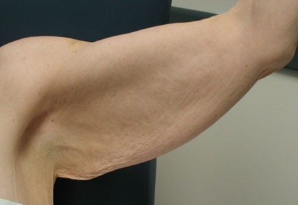 Brachioplasty (Arm Lift)
