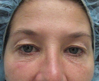 Blepharoplasty (Eyelid Surgery)