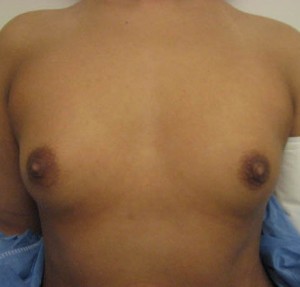 Breast Augmentation