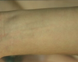 Laser Tattoo Removal