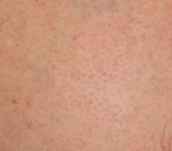 Laser Tattoo Removal