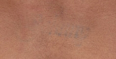 Laser Tattoo Removal