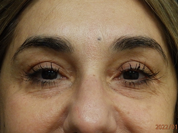 Blepharoplasty (Eyelid Surgery)