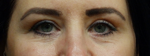 Blepharoplasty (Eyelid Surgery)