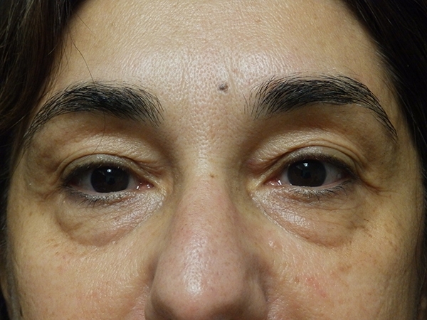 Blepharoplasty (Eyelid Surgery)